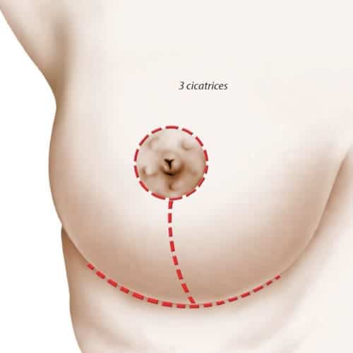 cicatrice t reduction mammaire avant apres reduction mammaire photos reduction mammaire prise en charge chirurgie mammaire chirurgien plasticien paris 16