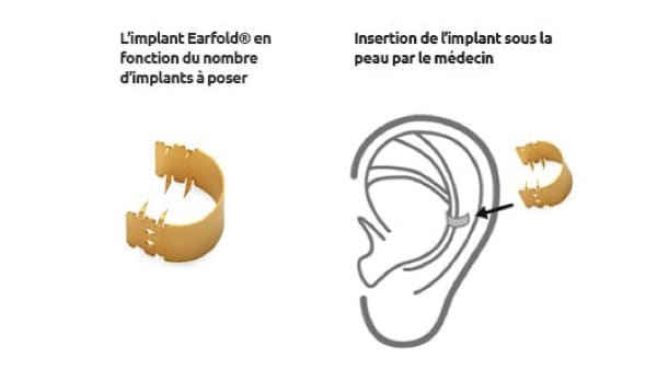earfold otoplastie prix otoplastie paris otoplastie remboursee chirurgie oreilles decollees chirurgie esthetique visage chirurgien plasticien paris 16