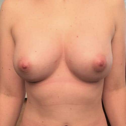 lipofilling mammaire avant apres lipofilling mammaire paris augmentation mammaire avec graisse chirurgie mammaire chirurgie esthetique chirurgien plasticien paris 16 apres 1