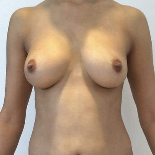 lipofilling mammaire avant apres lipofilling mammaire paris augmentation mammaire avec graisse chirurgie mammaire chirurgie esthetique chirurgien plasticien paris 16 apres 2