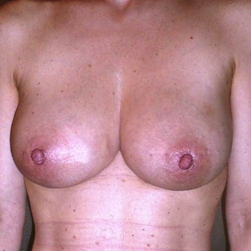 lipofilling mammaire avant apres lipofilling mammaire paris augmentation mammaire avec graisse chirurgie mammaire chirurgie esthetique chirurgien plasticien paris 16 apres 3