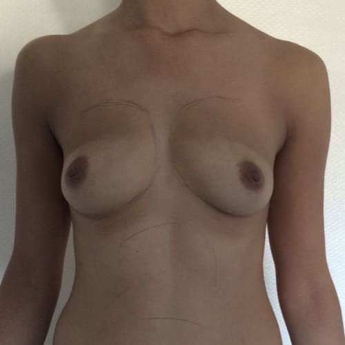 lipofilling mammaire avant apres lipofilling mammaire paris augmentation mammaire avec graisse chirurgie mammaire chirurgie esthetique chirurgien plasticien paris 16 avant 2
