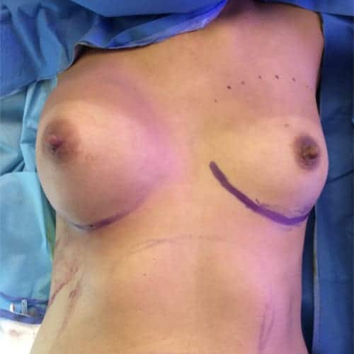 lipofilling mammaire bloc lipofilling mammaire paris augmentation mammaire avec graisse chirurgie mammaire chirurgie esthetique chirurgien plasticien paris 16 apres