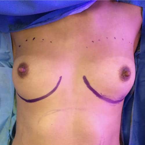 lipofilling mammaire bloc lipofilling mammaire paris augmentation mammaire avec graisse chirurgie mammaire chirurgie esthetique chirurgien plasticien paris 16 avant