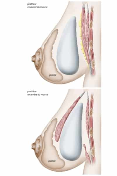 loge implant changement protheses mammaires remplacement protheses mammaires ablation protheses mammaires chirurgie mammaire chirurgien plasticien paris 16