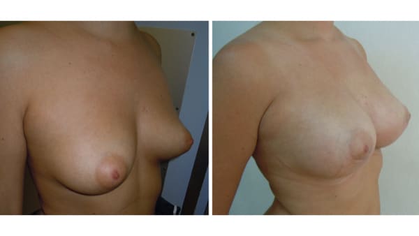 protheses mammaires avant apres 11 protheses mammaires paris implant mammaire paris chirurgie mammaire chirurgie esthetique chirurgien plasticien paris 16