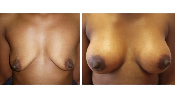 protheses mammaires avant apres 12 protheses mammaires paris implant mammaire paris chirurgie mammaire chirurgie esthetique chirurgien plasticien paris 16