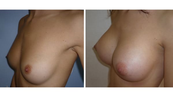 protheses mammaires avant apres 3 protheses mammaires paris implant mammaire paris chirurgie mammaire chirurgie esthetique chirurgien plasticien paris 16
