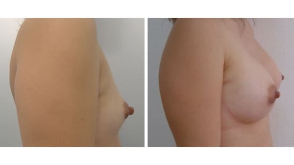 protheses mammaires avant apres 5 protheses mammaires paris implant mammaire paris chirurgie mammaire chirurgie esthetique chirurgien plasticien paris 16