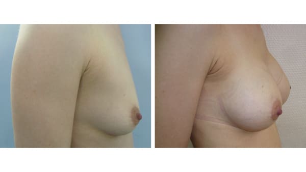 protheses mammaires avant apres 9 protheses mammaires paris implant mammaire paris chirurgie mammaire chirurgie esthetique chirurgien plasticien paris 16