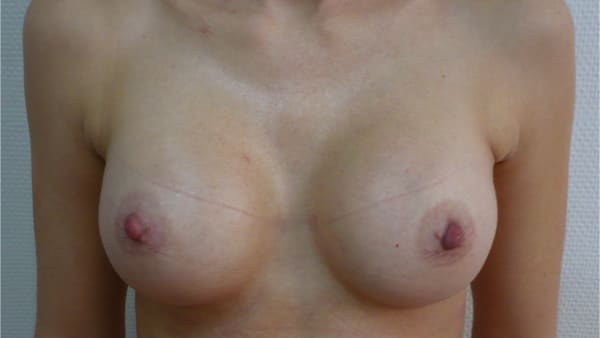 protheses mammaires avant apres protheses mammaires paris implant mammaire paris chirurgie mammaire chirurgie esthetique chirurgien plasticien paris 16 apres 14