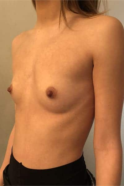 protheses mammaires avant apres protheses mammaires paris implant mammaire paris chirurgie mammaire chirurgie esthetique chirurgien plasticien paris 16 avant 18