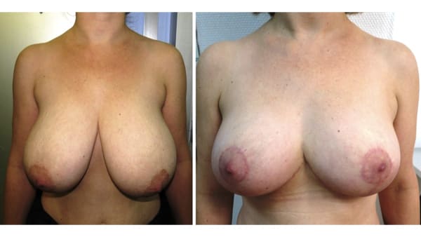 reduction mammaire avant apres 10 reduction mammaire photos reduction mammaire prise en charge chirurgie mammaire chirurgien plasticien paris 16
