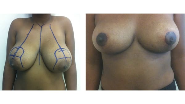 reduction mammaire avant apres 3 reduction mammaire photos reduction mammaire prise en charge chirurgie mammaire chirurgien plasticien paris 16