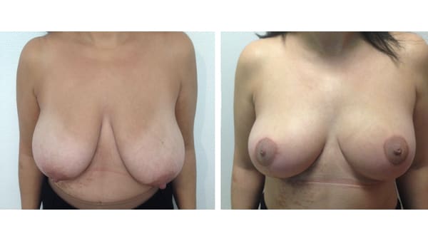 reduction mammaire avant apres 7 reduction mammaire photos reduction mammaire prise en charge chirurgie mammaire chirurgien plasticien paris 16