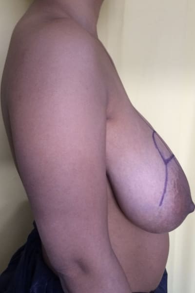 Before-Réduction mammaire avant-après