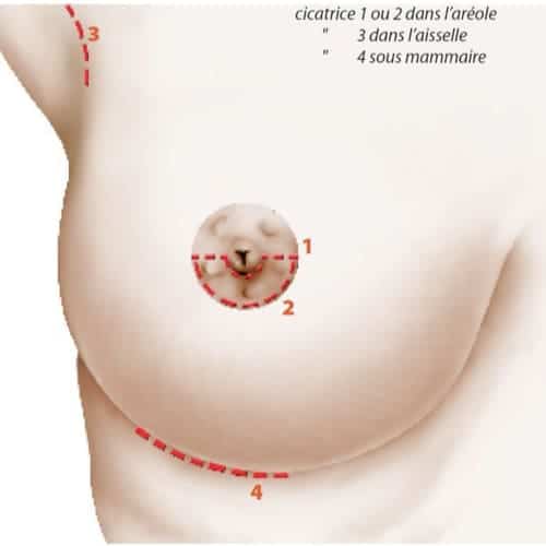 voies d abord protheses mammaires paris protheses mammaires avant apres implant mammaire paris chirurgie mammaire chirurgie esthetique chirurgien plasticien paris 16